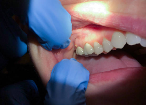 Best Emergency Tooth Extraction in Akron, IA